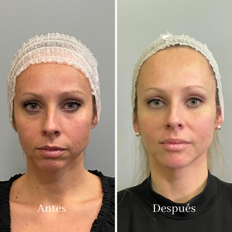 TODO LO QUE NECESITAS SABER SOBRE UN TRATAMIENTO FULL FACE