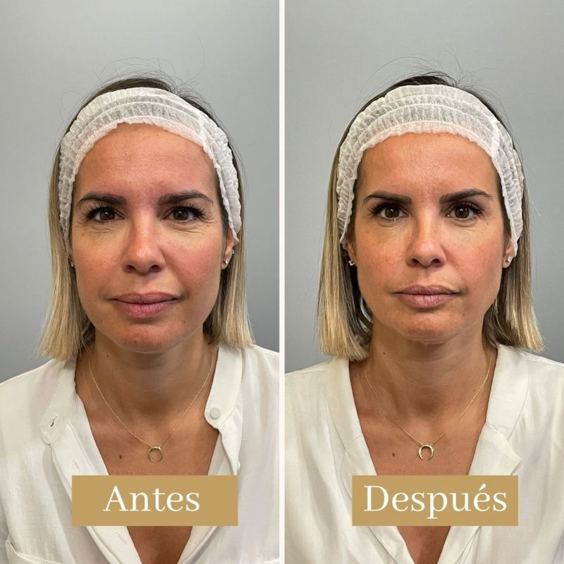 ¿QUÉ ES LA TOXINA BOTULÍNICA Y CÓMO FUNCIONA?