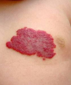 LO QUE DEBES SABER SOBRE LOS ANGIOMAS