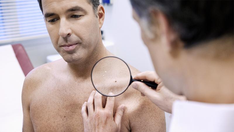 CÁNCER DE PIEL: CUANDO UN LUNAR CAMBIA DE COLOR