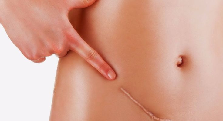 MICROPIGMENTACIÓN PARA CAMUFLAR LAS CICATRICES