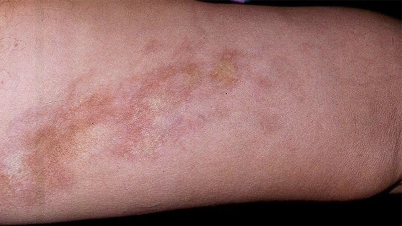 ESCLERODERMIA LOCALIZADA O MORFEA