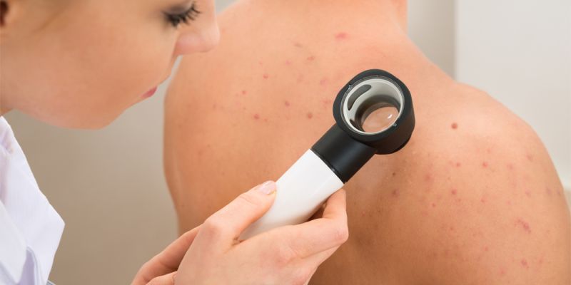 FOLICULITIS: CAUSAS, TIPOS Y TRATAMIENTO
