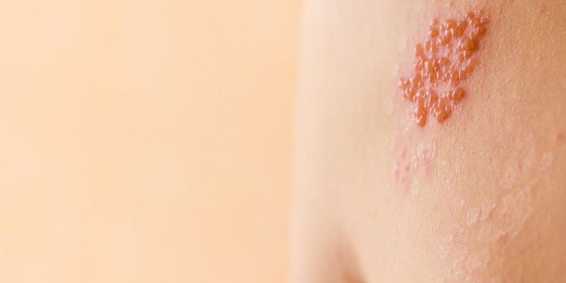 ¿QUÉ ES EL HERPES ZOSTER?