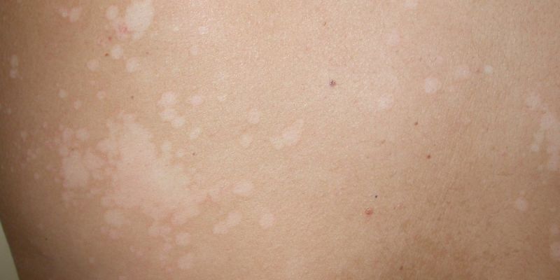 ¿HONGOS DE PLAYA O PITIRIASIS VERSICOLOR?