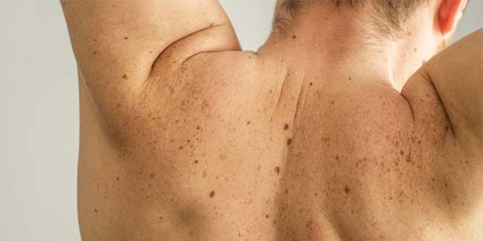 ¿POR QUÉ PICAN LOS LUNARES? ¿ES PELIGROSO?