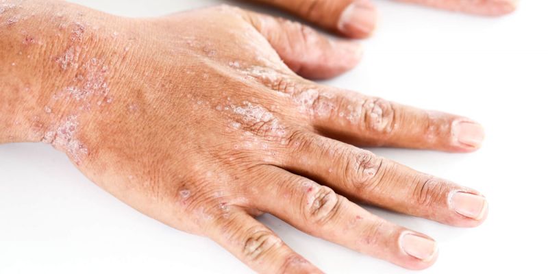 ¿SABES QUÉ ES LA PELAGRA?