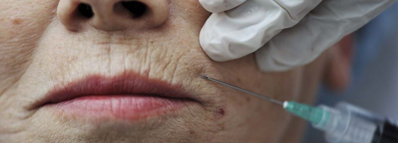 Rejuvenecimiento Facial con plasma rico en plaquetas o PRP