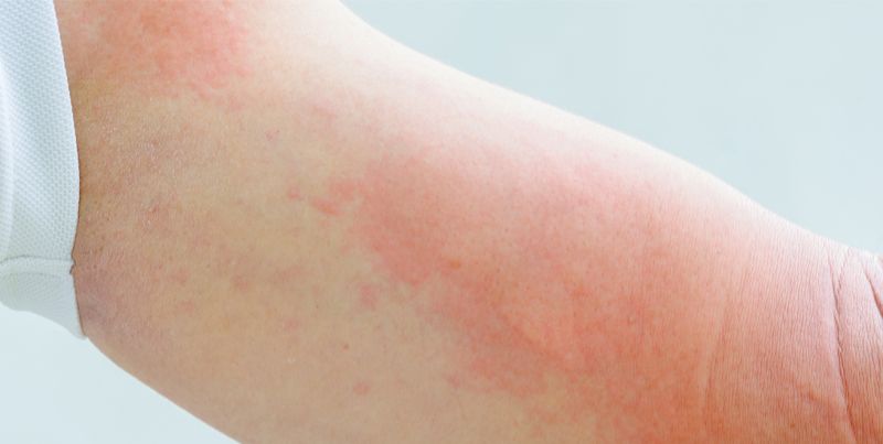 RECOMENDACIONES PARA PREVENIR LA URTICARIA