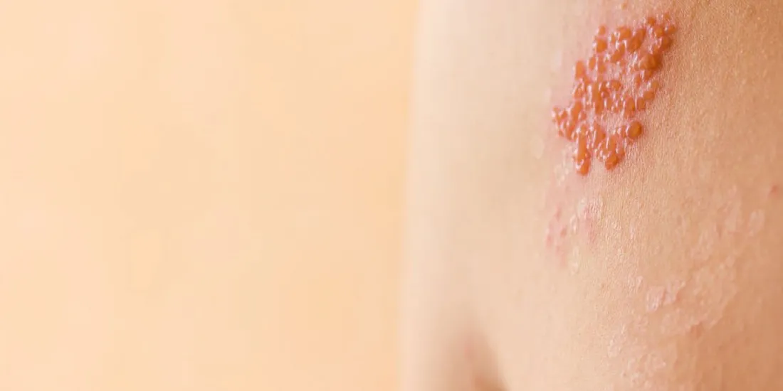 Qué es el Herpes Zoster? - Canarias Dermatológica